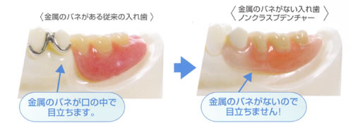 「今の入れ歯ではちょっと・・・」とお悩みの方に